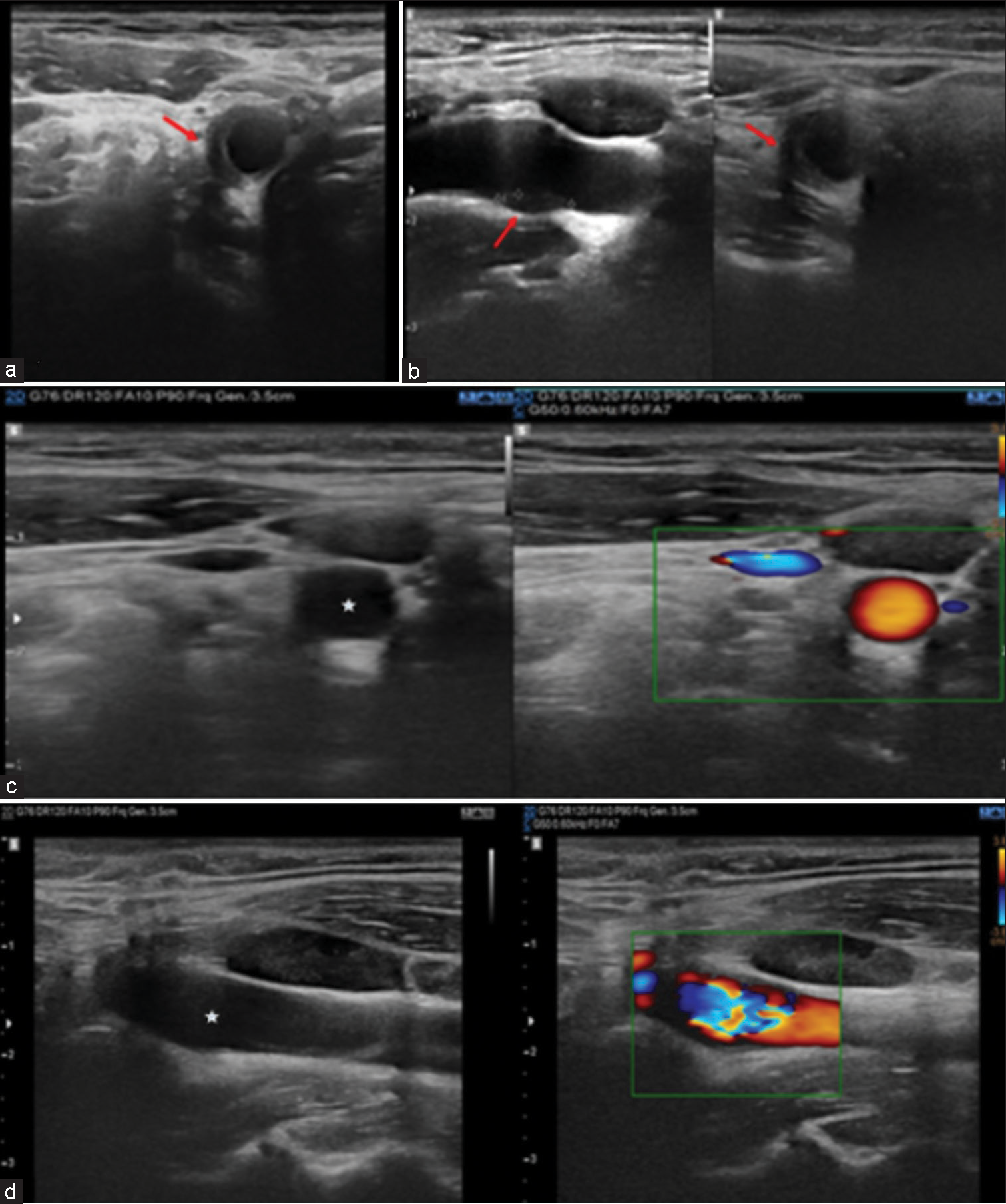 Ultrasound images demonstrating eccentric perivascular hyperechoic soft tissue (red arrow) in the right distal common carotid artery at bifurcation level in axial and sagittal plane (a and b). Follow-up ultrasound images (c and d) after 2-week post-non-steroidal anti-inflammatory drugs treatment complete resolution of eccentric perivascular hyperechoic soft tissue in the right distal common carotid artery at bifurcation level (white star).