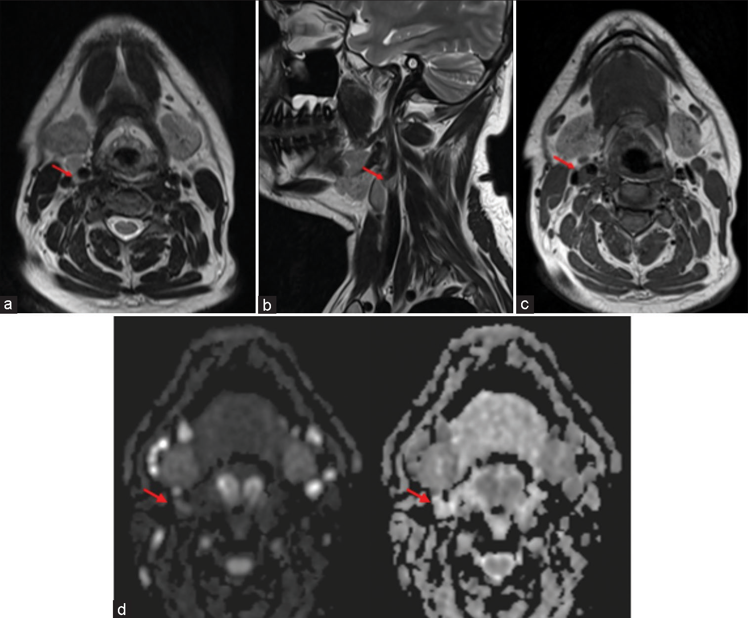 Axial T2-weighted image (a), sagittal T2-weighted image (b), axial T1-weighted image (c), and axial diffusion-weighted images (d) show T2 hyperintense, T1 hypointense (red arrows) eccentric adventitial thickening with high signal on diffusion-weighted imaging without drop on apparent diffusion coefficient.