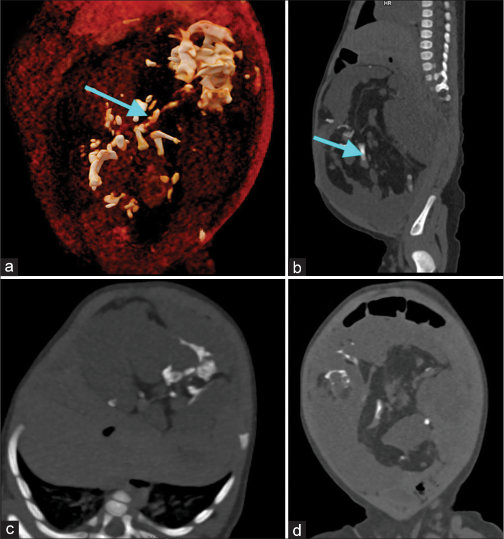 Plain computed tomography scan images of abdomen; (a) Volume rendered technique image shows appendicular skeleton like elements (blue arrow), (b) oblique sagittal shows appendicular skeleton like elements (blue arrow), (c) oblique axial and (d) oblique coronal images of the abdomen.