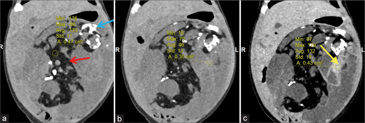 (a and b) Computed tomography images in coronal plane shows (red arrow) fat components, (blue arrow) coarse chunky calcifications in plain images and (c) venous phase images shows solid enhancing areas (yellow arrow).