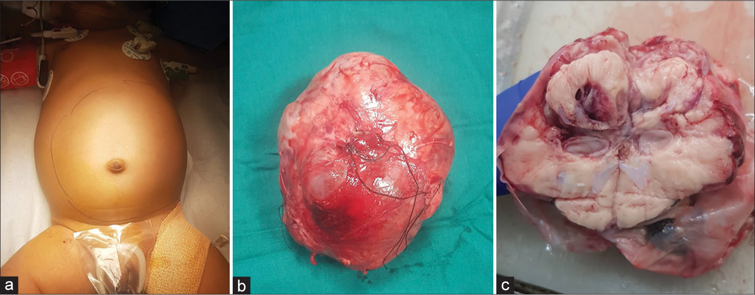 Clinical picture of the distended abdomen (a) tumor in toto (b) and (c) cuts section of the tumor.
