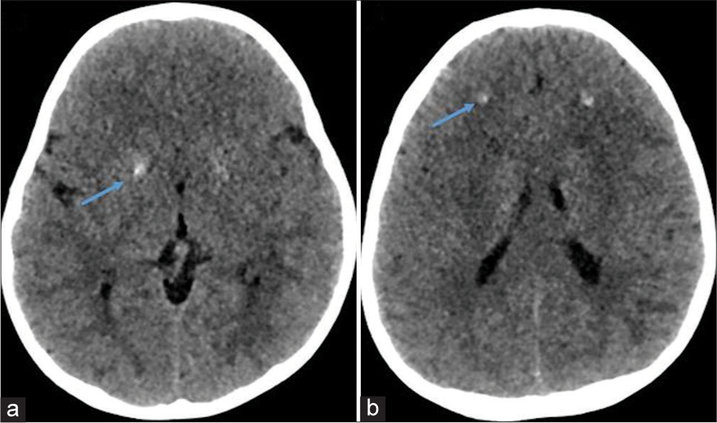 Computed tomography of the head (blue arrows in a and b) confirmed the presence of symmetric calcification in basal ganglia and frontal subcortical white matter.