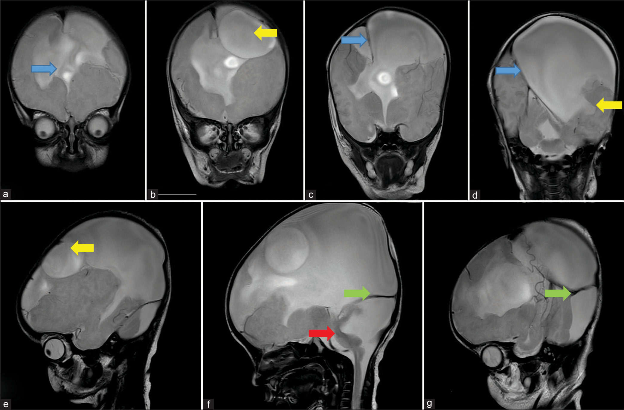Sequential coronal (a-d) and Sagittal (e-g) T2 weighted MRI images shows: (a) absence of anterior falx cerebri (blue arrow), (b) inter-hemispheric cyst (yellow arrow), (c) presence of falx cerebri in posterior aspect (blue arrow), (d) inter-hemispheric cyst communicating with lateral ventricle (yellow arrow) and presence of falx cerebri further posteriorly (blue arrow), (e) inter-hemispheric cyst (yellow arrow), (f) cerebellar hypoplasia with large posterior fossa cyst (red arrow) causing torcular inversion (green arrow) and, (g) High tentorium cerebelli signifying torcular inversion (green arrow).