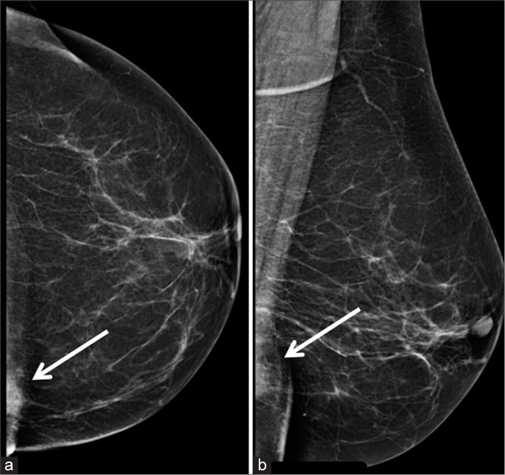 Breast cysticercosis mimicking malignancy: A case report from Nepal ...