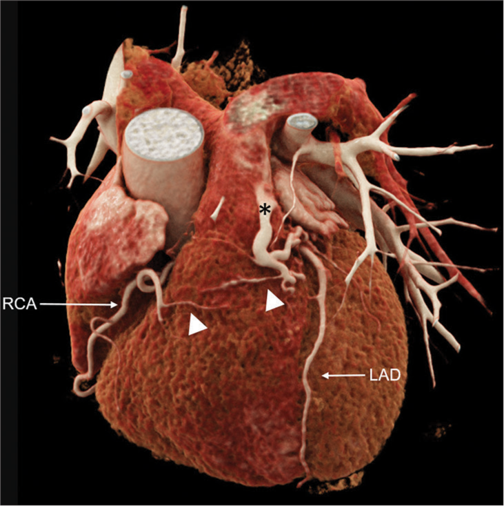 Cinematic 3D rendering of heart and coronary vessels shows fistula to the main pulmonary artery (*) with Vieussens’ ring branches (white arrowheads) communicating with fistula. LAD: Left anterior descending artery, RCA: Right coronary artery