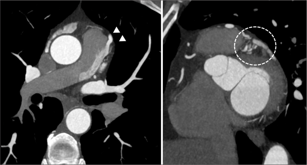 Maximum intensity projection reconstructions of the coronary computed tomography angiography show the site of fistula to main pulmonary artery (white arrowheads) and multiple fistulous vessels around the left anterior descending artery (dashed circle).