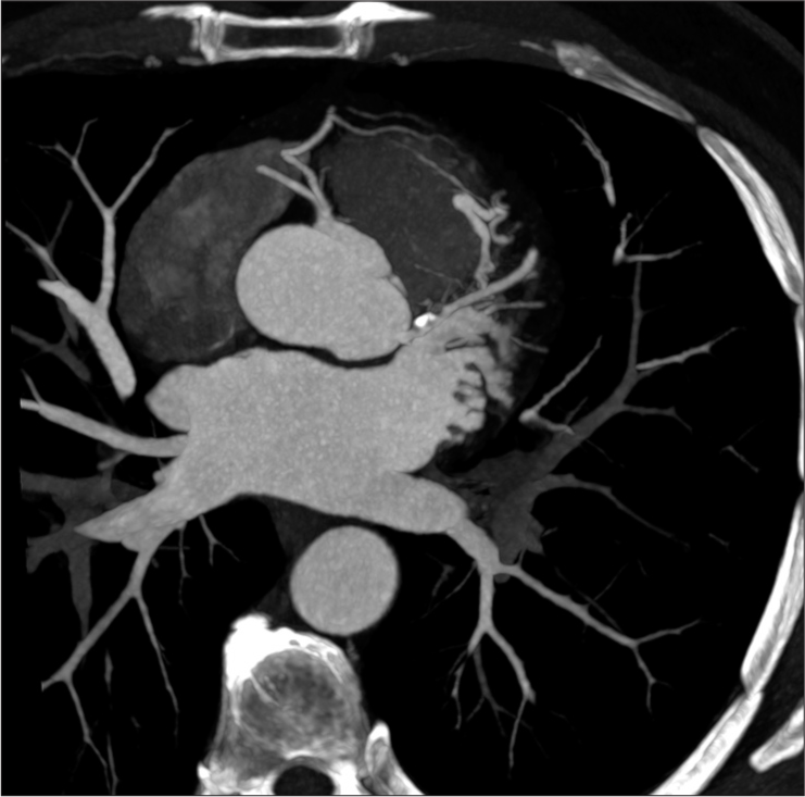 Supplementary image axial oblique computed tomography angiography showing tortuous Vieussens’ ring.