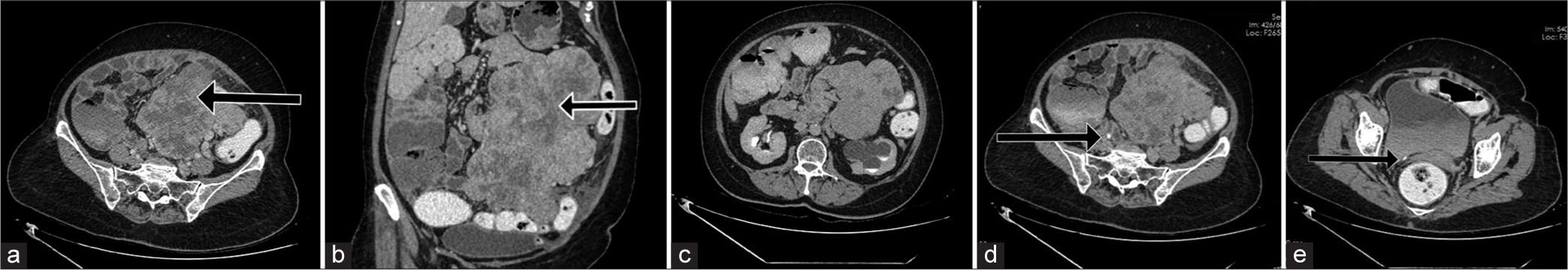 Sixty-year-old post woman presenting with abdominal distention and discomfort. (a) Contrast-enhanced computed tomography (CECT) image in venous phase axial section shows a heterogeneously enhancing soft-tissue density lesion in the left side of abdomen and pelvis (black arrow). (b) CECT image in venous phase coronal reformatted section shows non-enhancing areas within the lesion, suggestive of necrosis (black arrow). (c) CECT image in delayed phase shows delayed contrast excretion from the left hydronephrotic kidney. Left ureter not separately seen from the lesion. (d) depicts absence of contrast opacification in the left ureter in axial sections in delayed phase. Opacifed right ureter is seen (black arrow). (e) Section through lower pelvis shows no contrast filling in the left ureter. Arrow represents normally opacified distal right ureter.