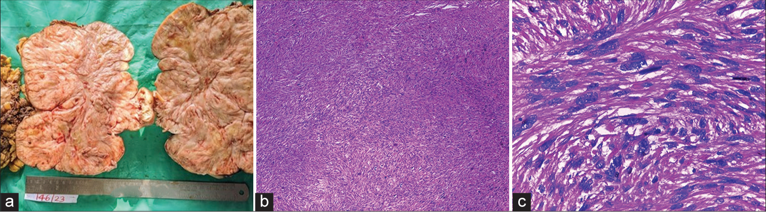 Sixty-year-old post woman presenting with abdominal distention and discomfort. (a) Gross pathology specimen cut surface appeared whitish whorled with focal yellowish areas, (b) microscopy demonstrates infiltrating neoplasm arising from the wall of ureter, composed of cells arranged interlacing fascicles, bundles and focal storiform pattern (Hematoxylin & Eosin 10x), and (c) magnified view shows individual cells that are spindle shaped with moderate eosinophilic cytoplasm and moderate to focal marked nuclear pleomorphism-findings in favor of malignant spindle cell neoplasm (Hematoxylin & Eosin 40x).