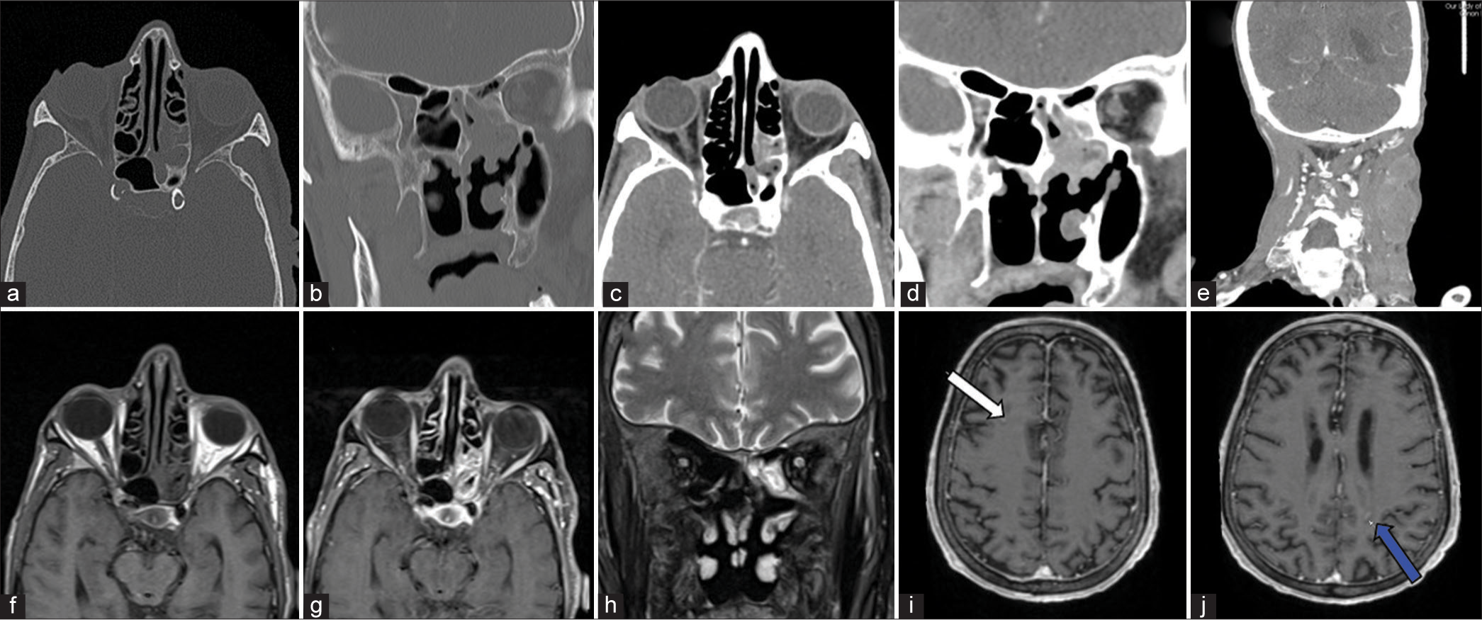 Imaging Of Extranodal Lymphomas In The Head And Neck A Case Series And Review Of The Literature 2512