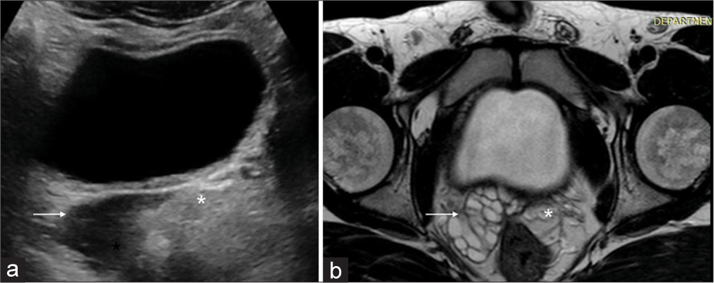 (a) Pelvic USG shows well defined elongated anechoic cystic structure (white arrow) in retrovesical and right periprostatic location. (b) Axial T2-weighted MRI image shows enlarged lobulated right seminal vesicle entirely replaced by multiple hyperintense cysts (white arrow) with non-visualisation of left seminal vesicle (asterisk in a and b).