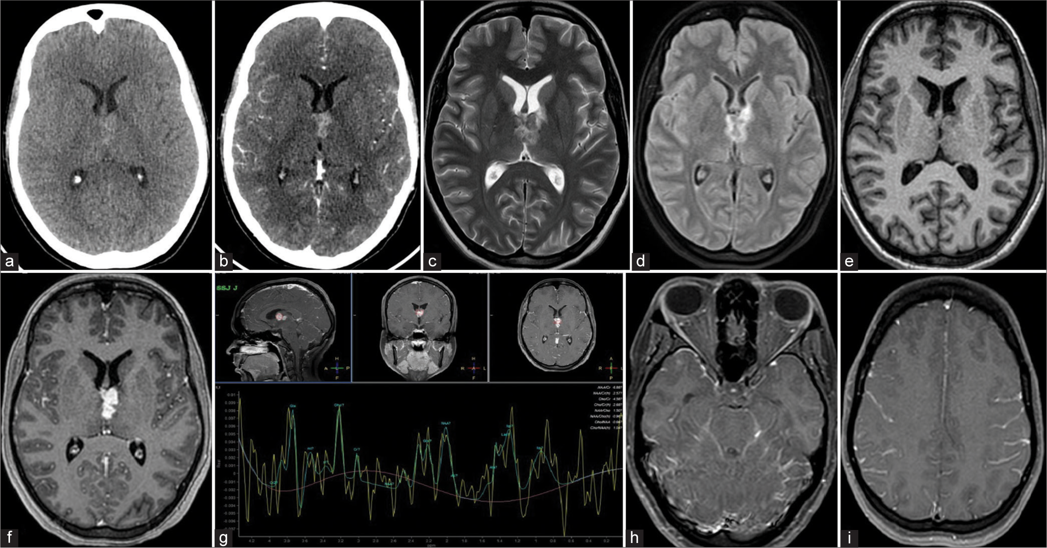 Computed tomography brain plain (a) and contrast (b) axial sections at the level of roof of the third ventricle show a relatively well-defined iso-hyperdense lesion with intense homogeneous post-contrast enhancement. Magnetic resonance imaging (MRI) brain T2 (c) and FLAIR (d) axial sections at the level of roof of the third ventricle show a T2 hypointense lesion which does not show suppression on fluid-attenuated inversion recovery (FLAIR) image. MRI brain T1 (e) and T1 gadolinium contrast (f) axial sections at the level of roof of the third ventricle show an iso-intense lesion which shows intense homogeneous post-contrast enhancement. Magnetic resonance-spectroscopy (g) shows a lipid lactate peak at 1.3 ppm. MRI brain T1 contrast axial images at the level of basal cisterns (h) and fronto-parietal sulci (i) show enhancement of basal cisterns and lepto-meningeal thickening/enhancement.
