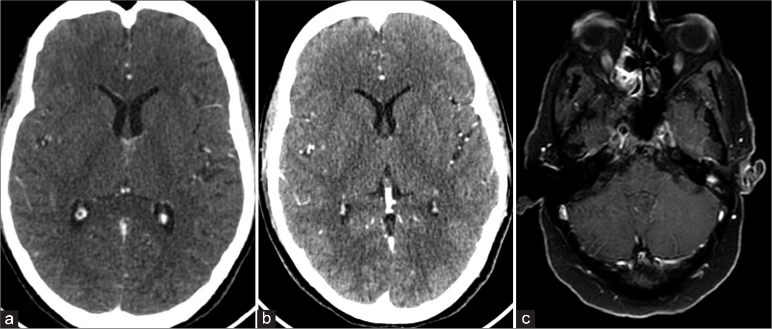 (a) Follow-up computed tomography (CT) brain contrast axial image of case 1 after 3 months of ATT at the level of the roof of the third ventricle shows a reduction in size and intensity of enhancement of the lesion. (b) Follow-up CT brain contrasts the axial image of case 1 after 6 months of ATT at the level of the roof of the third ventricle shows further reduction in size and intensity of enhancement of the lesion. (c) Follow-up magnetic resonance imaging brain contrasts the axial image of case 2 after 3 months of ATT shows a significant reduction in thickening and enhancement of pachymeninges in the left temporal region. ATT: anti-tuberculosis treatment.