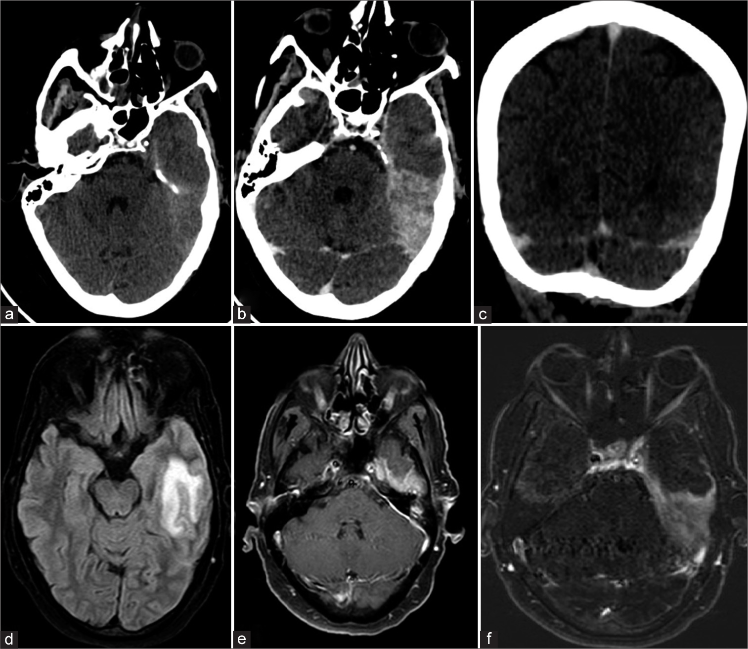 Computed tomography (CT) brain plain (a) and contrast (b) axial sections show thick hyperdense left tentorium cerebelli with post-contrast enhancement and minimal left temporal lobe edema. CT contrast coronal (c) section shows no evidence of enhancing mass lesions or dural venous sinus thrombosis. Magnetic resonance imaging (MRI) of brain flair (d) axial section shows hyperintensity in the left temporal lobe. MRI brain T1 gadolinium contrast (e) and T1 post-contrast subtracted image (f) axial section shows focal abnormal pachymeningeal thickening and enhancement in the left temporal region.