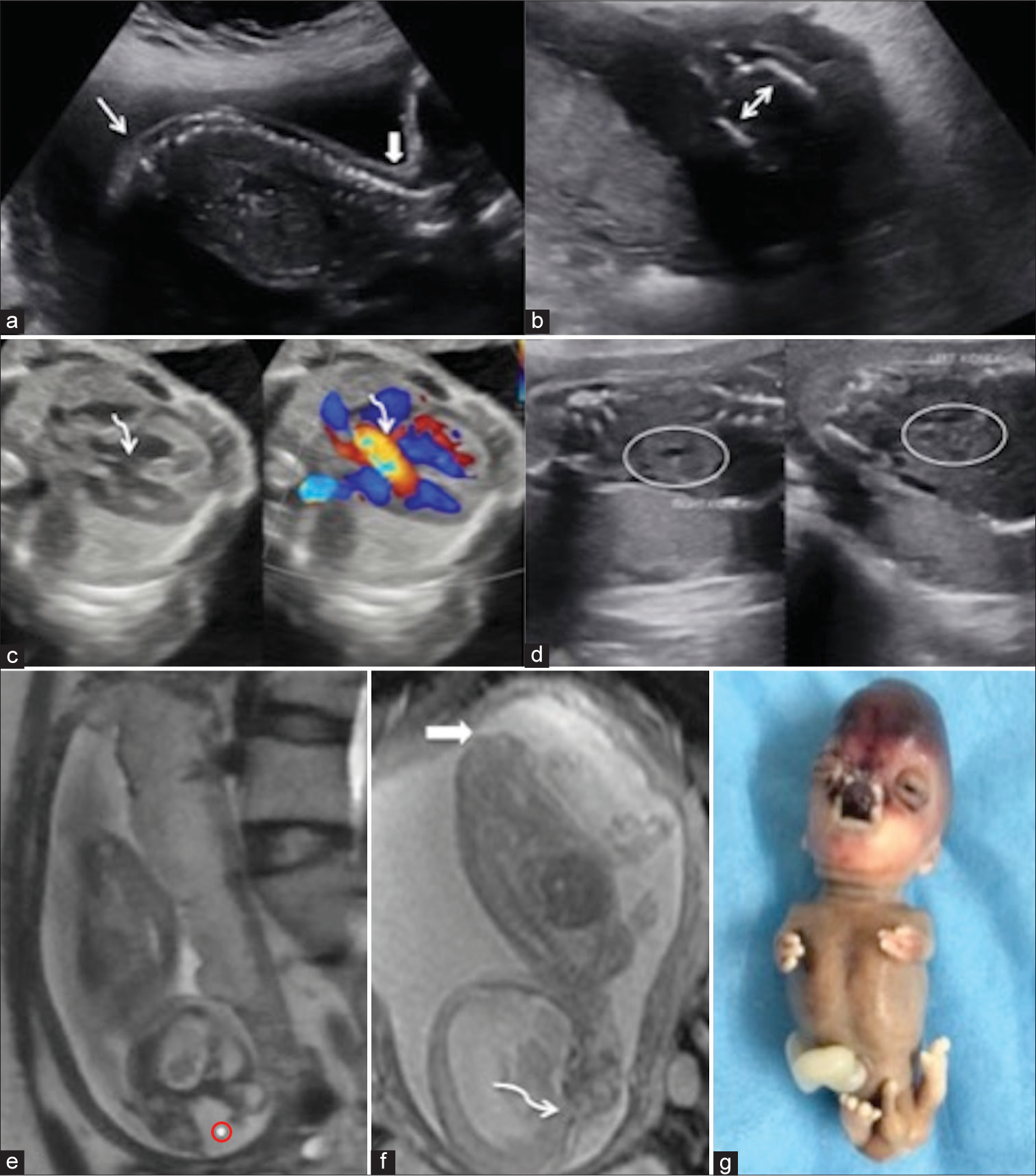 (a) Sagittal image of Fetal spine showed loss of sacral uptilt (white arrows) with no visualization of sacral and lower lumbar vertebrae. (b) Axial section through the pelvis showed mildly apposed iliac bones (double sided white arrow) suggesting lumbosacral dysgenesis. (c) Gray scale axial ultrasonography image through chest shows a 4 chambered heart with a defect in interventricular septum in perimembranous region (curved white arrow) showing color doppler flow (curved white arrow). (d) Bilateral kidneys (white oval circles) appear enlarged (right more than left) and show few anechoic cysts within. The renal parenchyma in right kidney also shows raised echogenicity. (e) Fetal magnetic resonance imaging (MRI) shows midline defect in nasoethmoidal region with protrusion of a T2 hyperintense mass (red circle with dot) in midline. (f) Sagittal MRI images through face show continuity of the tissue with cerebral parenchyma (curved white arrow) with Slight T2 heterointense lesion in the sacral region (solid white arrow). (g) Post-medical termination of pregnancy clinical image of fetus showing tetraphocomelia with tetraoligodactyly, dysmorphic facial morphology with frontal bossing, midline facial cleft, hypertelorism, dysplastic cerebral tissue in nasoethmoidal region showed blackish appearance. Enlarged phallus could be appreciated.