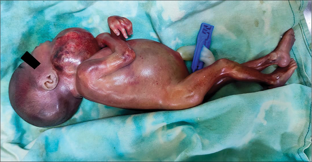 Gross specimen of abortus with the large cervical mass.