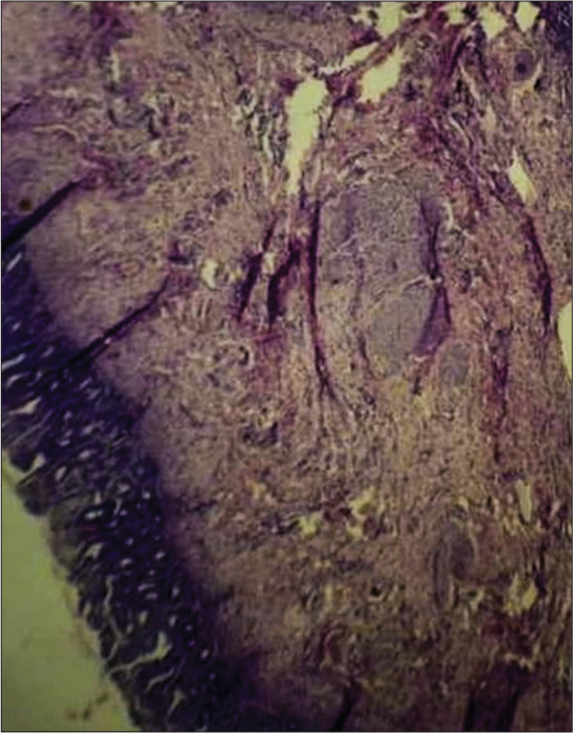 Microscopic slide from histopathology of the mass confirming teratoma (Hematoxylin & Eosin stain, 20X).
