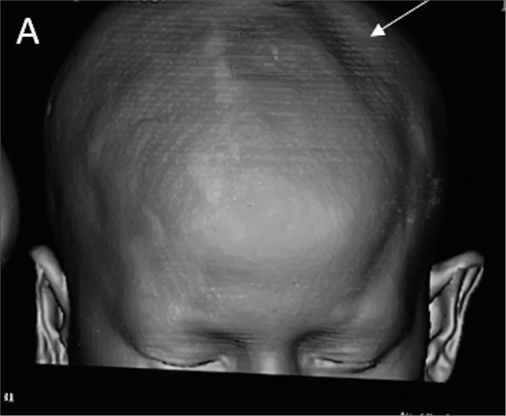 3D reconstructed computed tomography shows asymmetric thinning of left parietal bone (white arrow).