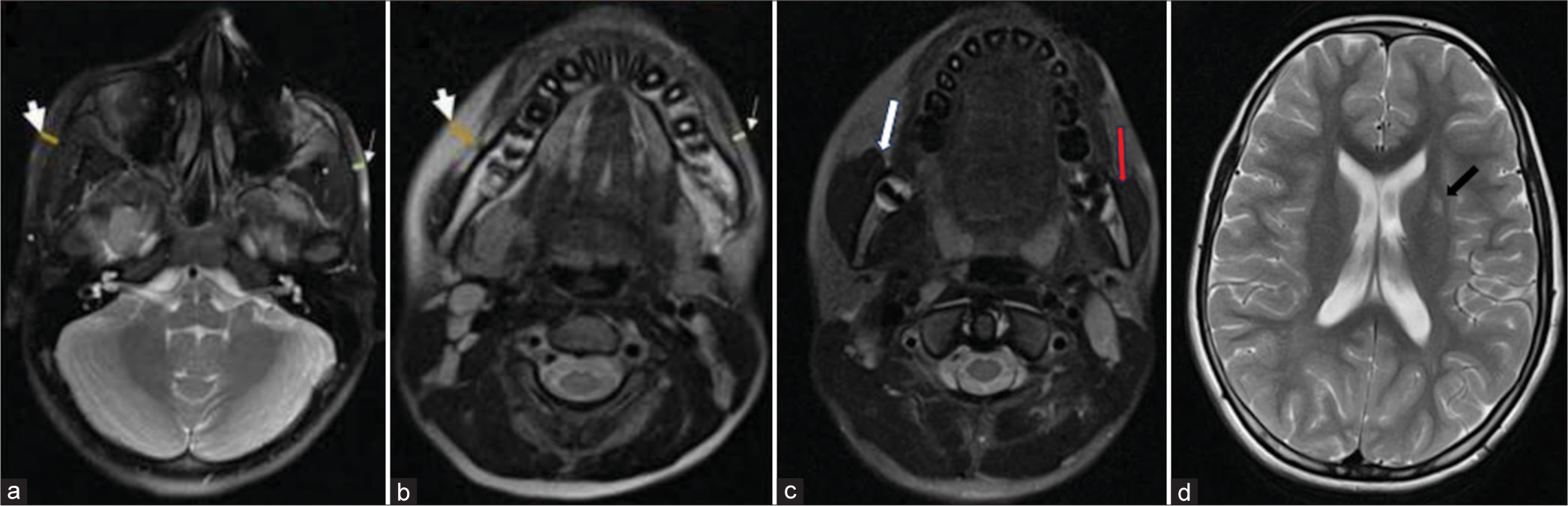 (a and b) Magnetic resonance imaging of brain showing asymmetric atrophy of skin and subcutaneous tissue on left side (thin arrows) as compared to that on the right side (thick arrows); (c) atrophy of masticator group of muscles on left side (red arrow) as compared to that on right side (white arrow); (d) abnormal T2 hyperintense foci in left lentiform nucleus (black arrow).