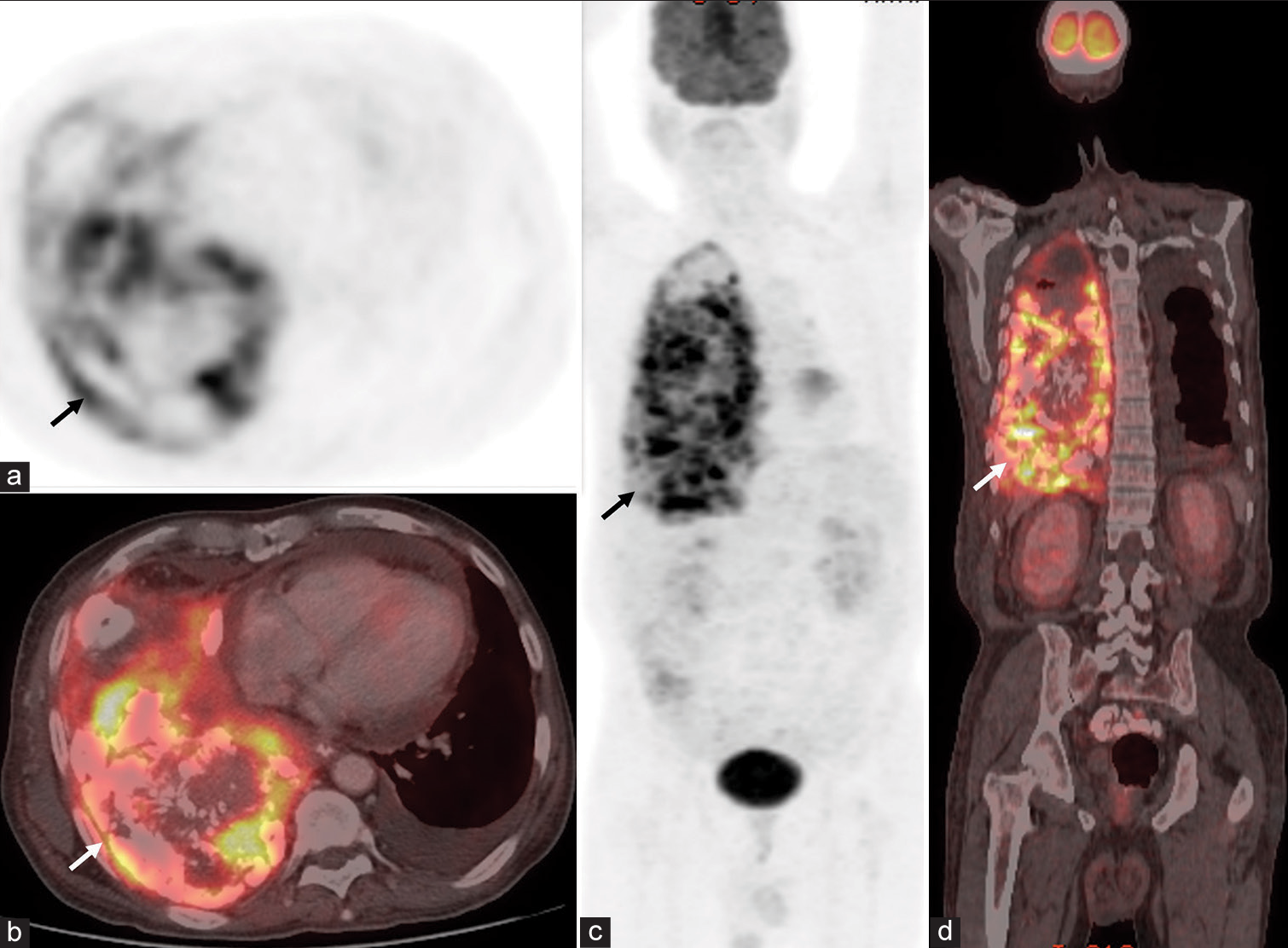 (a-b) Axial chest positron emission tomography (PET) and fusion positron emission tomography/computed tomography (PET/CT) images show hypermetabolic mass with calcifications/ ossifications in right lung (arrows). Left pleural effusion is also seen. (c-d) Whole body PET and fusion PET/CT images show the right lung lesion (arrows). No other malignant lesion is seen.