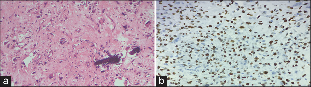 (a) Hematoxylin and eosin Stain (H&E ×40): The tumor cells show densely eosinophilic cytoplasm resembling osteoblasts along with thin, lace-like osteoid suggestive of osteosarcoma. (b) Immunohistochemistry: Special AT-rich sequence-binding protein 2 (SATB2 ×100) stain shows nuclear positivity confirming the diagnosis.