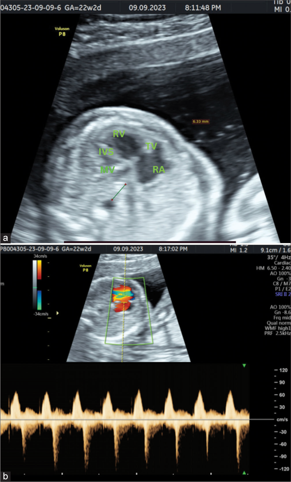 A 20-year-old female patient came for anomaly assessment. (a) Four-chamber view shows dilated right ventricle and right atrium with severely hypoplastic left heart chambers. There is also increased distance between descending aorta and the left atrium with abnormal vessel in between. (b) Spectral Doppler image of four-chamber view shows mild tricuspid regurgitation. RA: Right atrium; RV: Right ventricle; IVS: Interventricular septum; MV: Mitral valve; TV: Tricuspid valve.