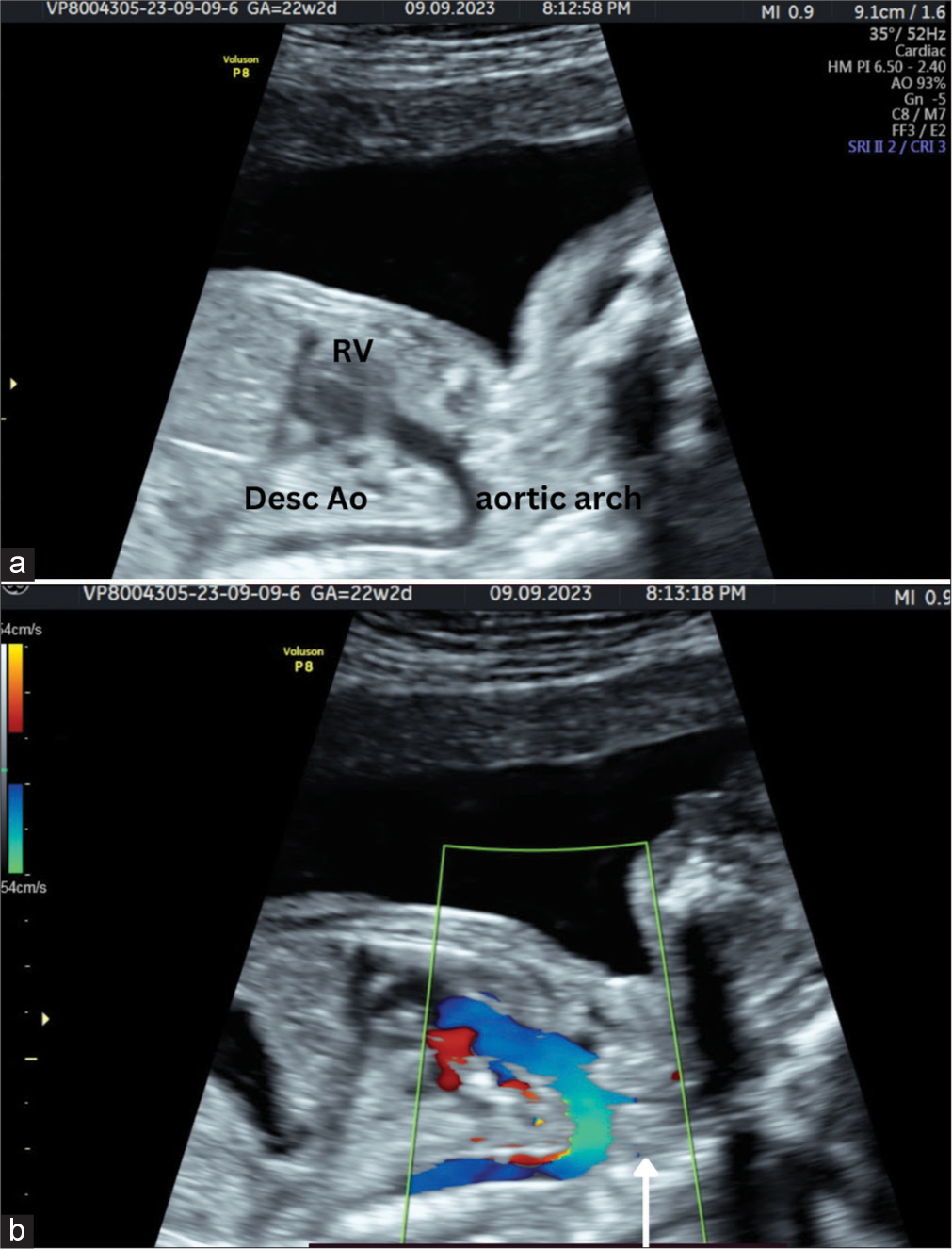 A 20-year-old female patient came for anomaly assessment. (a) Gray scale image and (b) Spectral Doppler image of paramedial sagittal plane shows dilated aorta arising from right ventricle. The left common carotid artery is seen arising from aortic arch (white arrow). RV: Right ventricle.