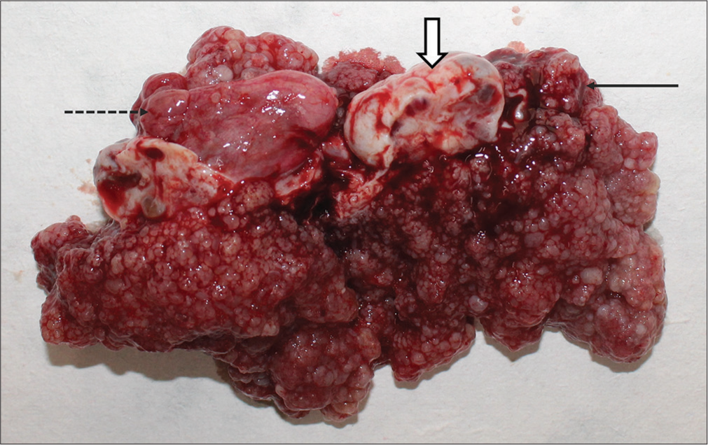 Gross specimen showing frond like appearance of the mass (black arrow) encasing the left ovary (white block arrow) and right ovarian cyst (dotted black arrow).