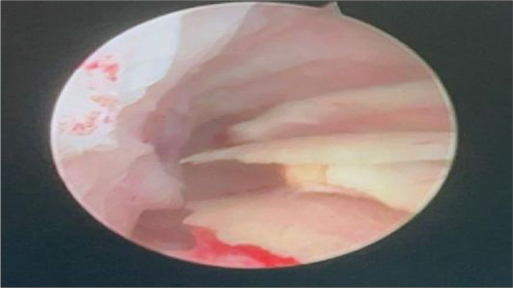Diagnostic hysteroscopic examination reveals multiple bony spicules in the endometrial cavity directed to the posterior uterine wall.
