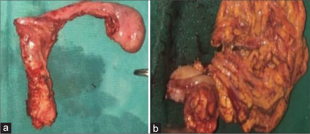 A 25-year-old phenotypic male patient presented with complaint of abdominal pain. (a) Gross specimen image of resected rudimentary uterus, (b) Gross image of resected hemicolectomy specimen.