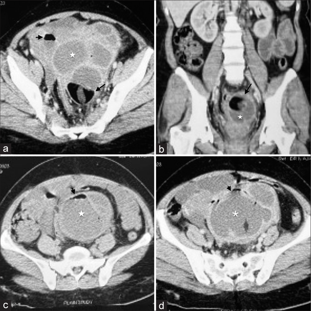 CT images of the pelvic mass. (a) Axial CECT image shows multiloculated cystic lesion (white asterisk) with enhancing walls and septations, fatty components (black long arrow) and small pocket of air (black short arrow), (b) Coronal CECT image shows the fatty component (white asterisk) and wall enhancement (black arrow), (c) Non contrast axial image shows air-fluid level (black arrow) in the cyst (white asterisk), (d) Axial post contrast image showing multiloculated cyst with enhancing walls and septations (white asterisk) and air pockets (black arrow).