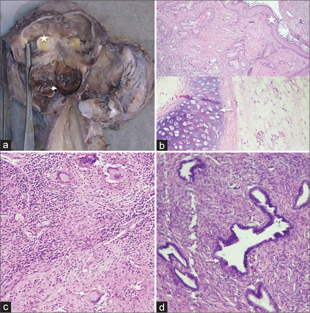 Gross and histopathology. (a) Gross specimen of the ovaries showing the fatty (white asterisk) and the endometriotic (white arrowhead) components which are seen as “chocolate”/hemorrhagic components in the enlarged ovary. (b) Ovarian cyst lined by squamous epithelium (white asterisk) containing adipose and mature cartilage (white arrow) components suggestive of dermoid. (c) Areas of granulosuppurative inflammation with Langerhans-type giant cells (white arrow). (d) Endometriotic glands (white arrow) with hemorrhage in the ovaries.