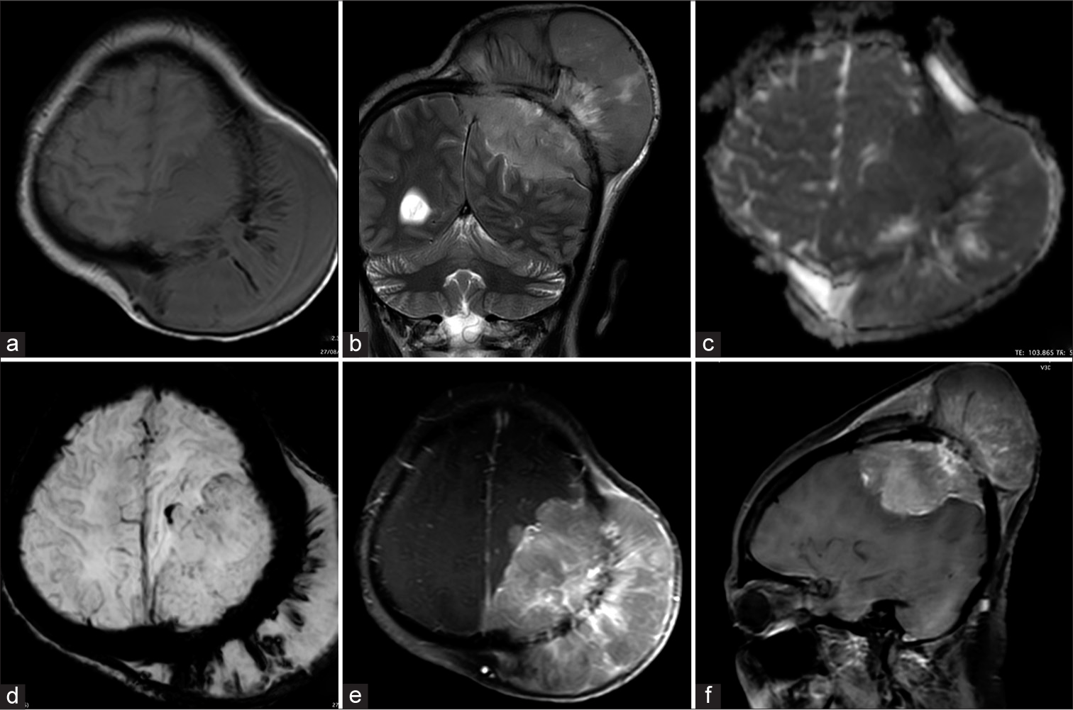 Magnetic resonance imaging (MRI) shows an area of marrow signal alteration in the left parietal bone with a large extraosseous soft-tissue mass having an extradural component. The patient had presented with the large scalp component of the mass. (a) The mass is isointense on T1WI, (b) hyperintense on T2WI and (c) shows diffusion restriction. Extensive spiculated sunburst type of periosteal reaction with new bone formation is seen along the extracranial aspect of the lesion. (d) Susceptibility weighted imaging (SWI) images shows the periosteal reaction very well. (e, f) On post contrast intense heterogeneous enhancement of the lesion is seen.
