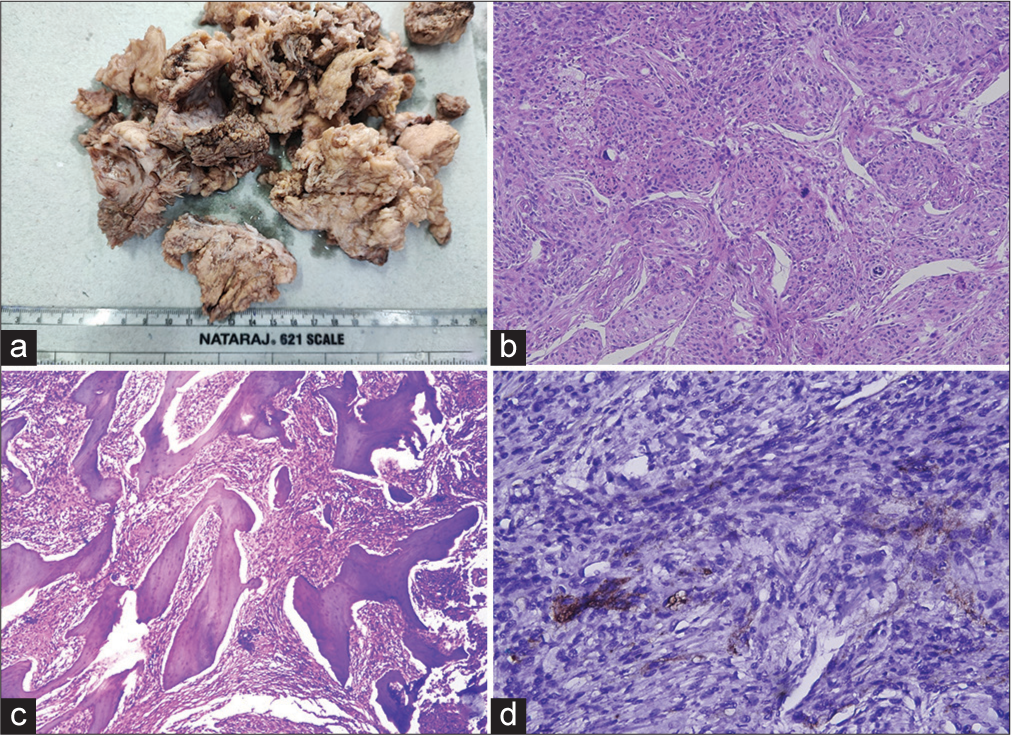 (a) Grossly the tumor was tan-grey and predominantly solid. (b) Sections (200x) show proliferation of spindle cells with syncytial and whorling pattern at places. Few psammoma bodies seen. 4 to 5 mitotic figures noted /10 high power fields. Focal patchy areas of increased cellularity, small cells with high nuclear-cytoplasmic (N/C) ratio, large and prominent nucleoli, patternless or sheet-like growth (loss of lobular architecture) and foci of spontaneous or geographic necrosis noted. (c) Few bone bits noted with adhered and entrapped tumor tissue (100x). (d) On immunohistochemistry (200x), strong patchy cells were positive for EMA and PR, negative for GFAP, STAT6, S100. Ki67 proliferative index is 20-25% in hot spot areas. The final histopathological diagnosis favoured an atypical meningioma (WHO grade 2).