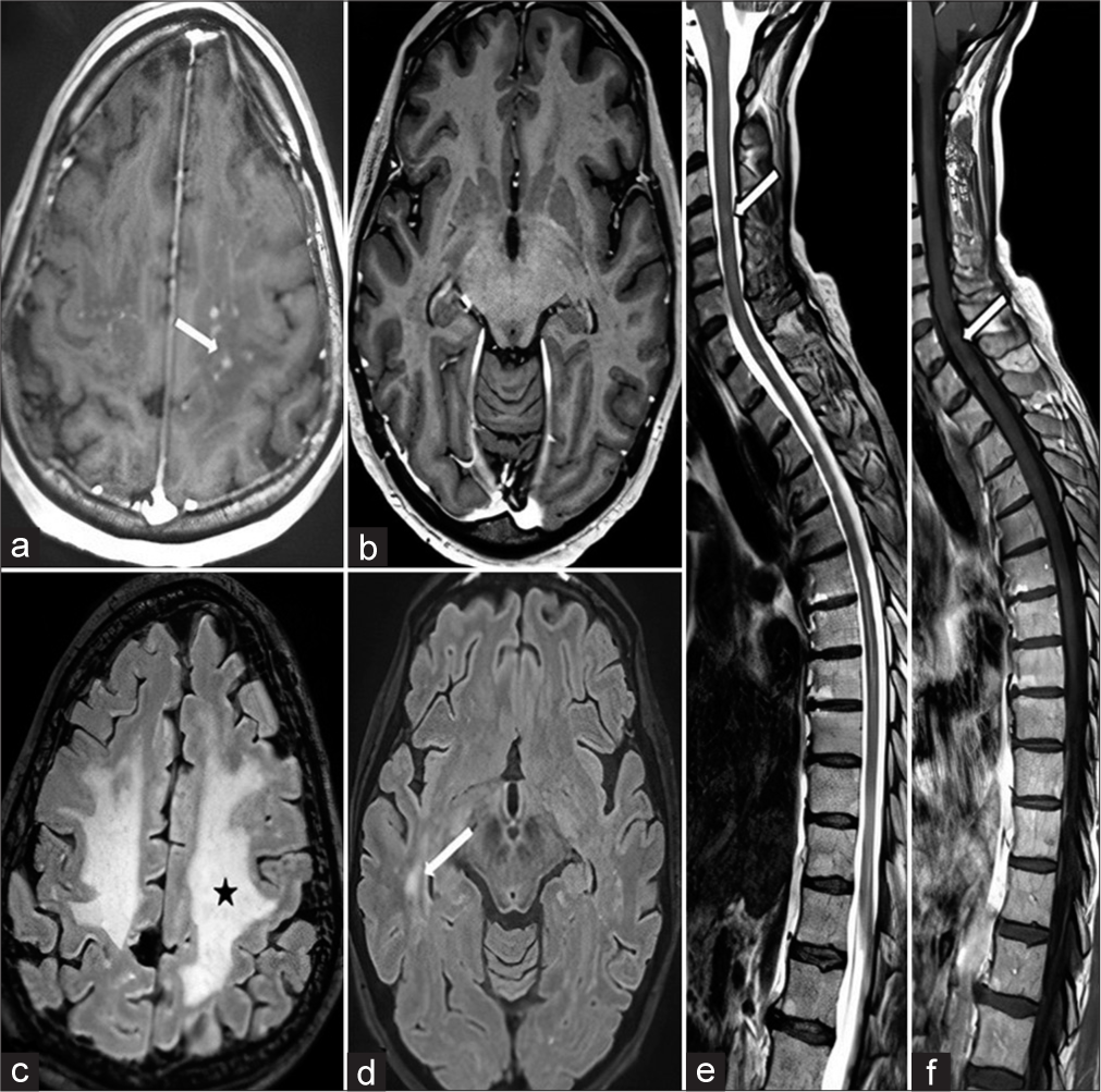 Magnetic resonance imaging taken 1 month after starting the treatment. (a) Axial post-contrast T1 weighted section revealed a few residual nodular contrast enhanced white matter lesions seen in centrum semiovale region (white arrow). (b) Axial post-contrast T1 weighted section also revealed complete disappearence of contrasted lesions in temporo-occipital region. (c and d) Axial FLAIR sections revealed reduced vasogenic edema seen in centrum semiovale region (black star) and significant reversal of hyperintensities in temporo-occipital region (white arrow), respectively. (e) Sagittal T2 weighted section revealed edema almost completely regressed with a few residue signals (white arrow). (f) Sagittal post-contrast T1-weighted section revealed almostly disappearence of contrasted lesions (white arrow).