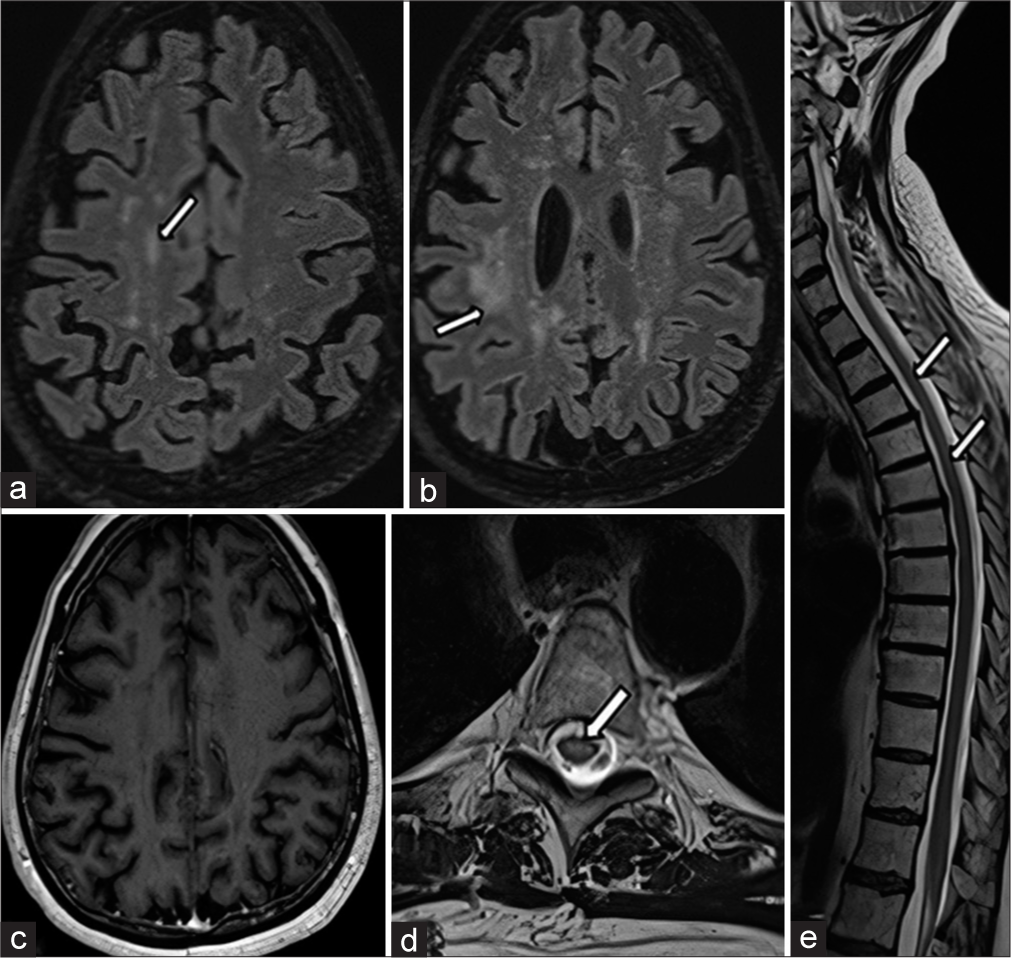 Magnetic resonance imaging taken 7 months after starting the treatment. (a and b) Axial fluid-attenuated inversion recovery sections revealed mild residual sequel gliotic white matter intensities (white arrows) with accompanying prominent parenchymal atrophy (which can easily be distinguished when compared with initial images). (c) Axial post-contrast T1 weighted sections revealed a complete reversal of cerebral contrast-enhanced nodules seen in the centrum semiovale region. (d and e) Axial and sagittal T2-weighted sections revealed gliosis in the central regions with detectable cord atrophy at cervical and thoracic locations (white arrows), respectively.