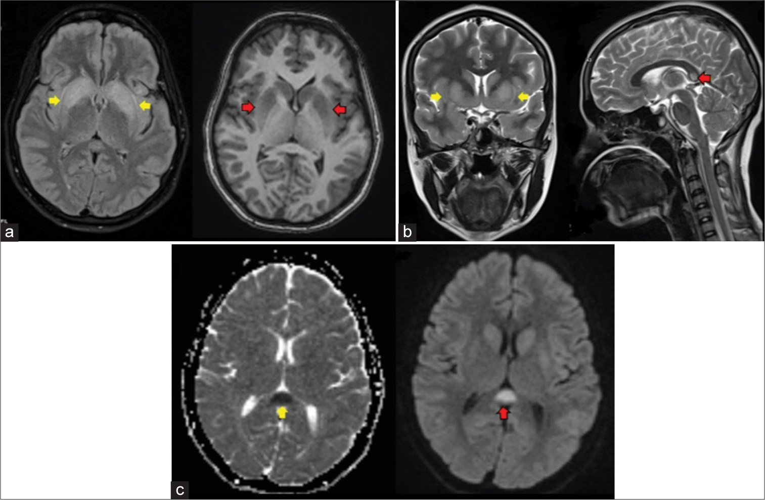 A 24-year-old woman with autoimmune encephalitis who presented with altered sensorium (a) FLAIR-axial shows hyperintensity in bilateral basal ganglia (yellow arrows), T1-axial shows hypointensity in bilateral basal ganglia (red arrows) (b) T2-coronal shows hyperintensity in bilateral basal ganglia (yellow arrows), T2-sagittal shows hyperintensity in splenium of corpus callosum (red arrow), (c) Apparent diffusion coefficient (ADC)-axial shows hypointensity in splenium of corpus callosum (yellow arrow), Diffusion weighted imaging (DWI)-axial shows hyperintensity in splenium of corpus callosum (red arrow).