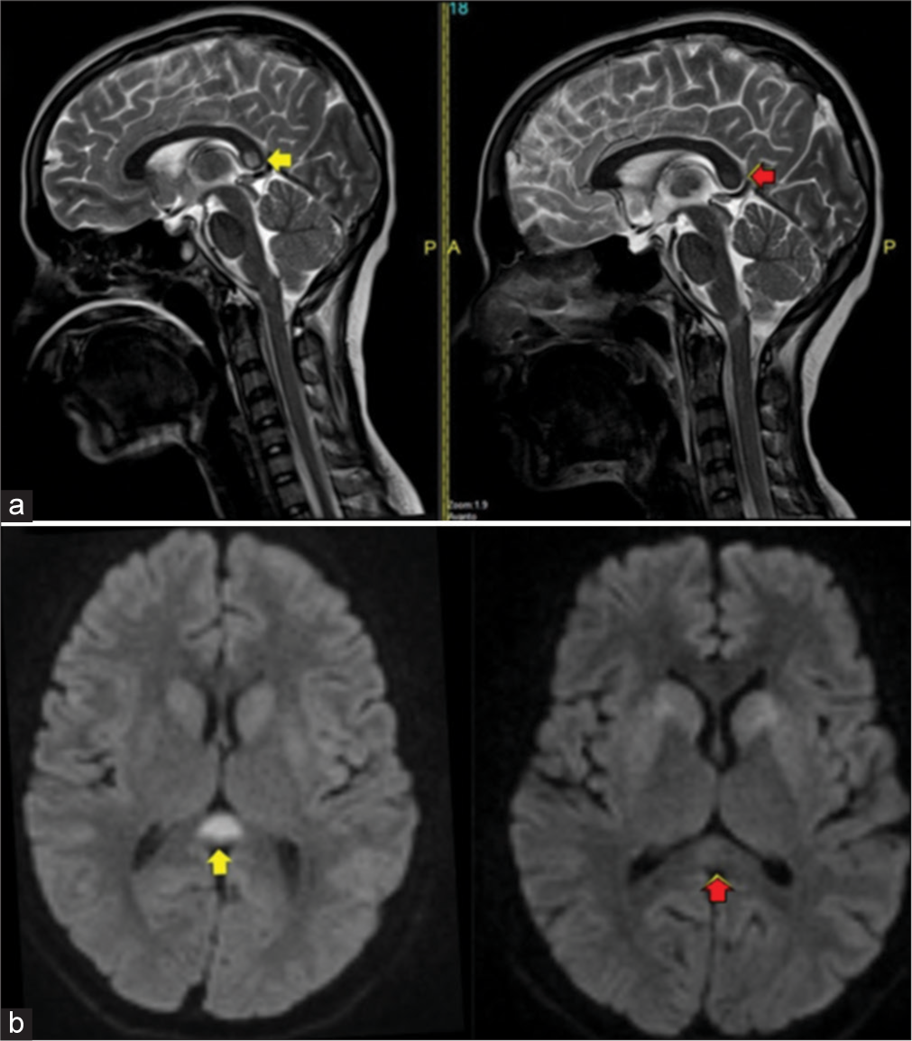 A 24-year-old woman with autoimmune encephalitis who presented with altered sensorium (a) T2-sagittal shows hyperintensity in splenium of corpus callosum at presentation (yellow arrow), T2-sagittal shows significant decrease of hyperintensity after 2 weeks (red arrow) (b) DWI-axial shows restricted diffusion in splenium of corpus callosum at presentation (yellow arrow), DWI-axial shows significant decrease of restricted diffusion after 2 weeks (red arrow).