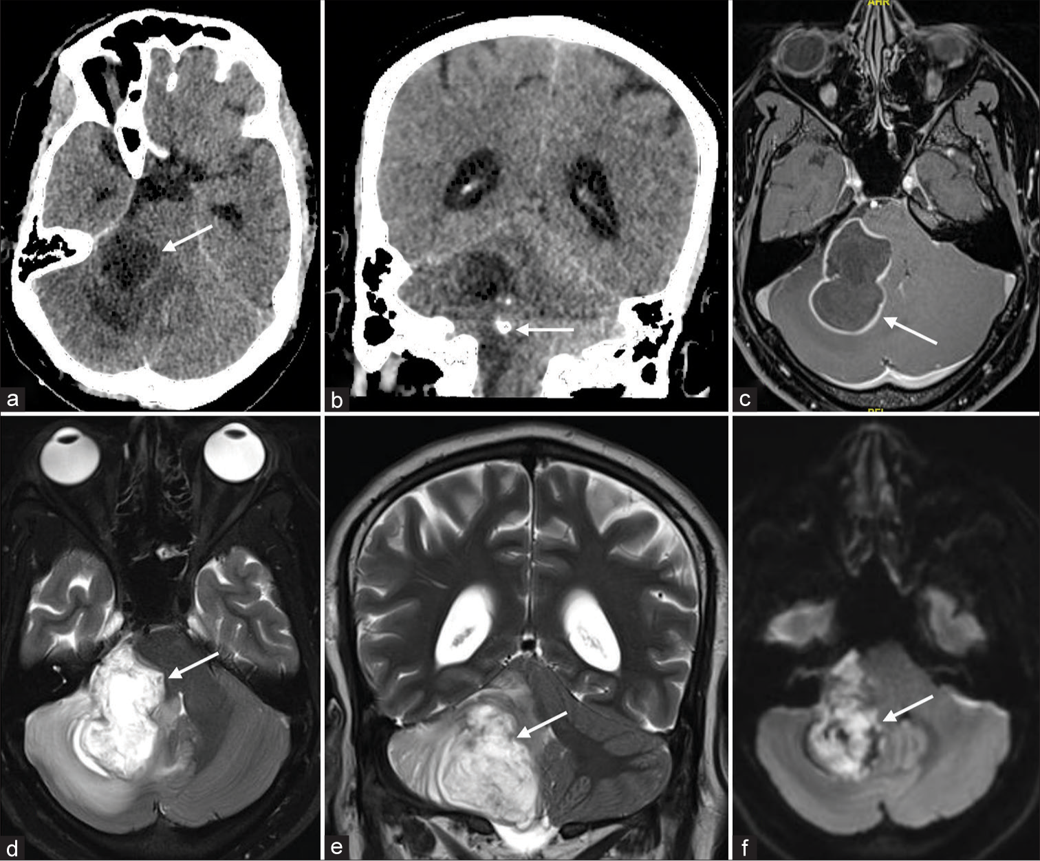(a) Computed tomography (CT) shows a cystic mass like lesion in the right cerebellar hemisphere (white arrow). (b) CT demonstrates an eccentric nodular calcification (white arrow). T1W post contrast MR, (c) shows peripheral wall enhancement (white arrow). T2 weighted axial and coronal MR images (d and e respectively) demonstrates cystic nature of the lesion with involvement of the right middle cerebellar peduncle and an exophytic component along the right side of pons (white arrows). Diffusion sequence (f) shows central restriction diffusion (white arrow). MR: Magnetic resonance.