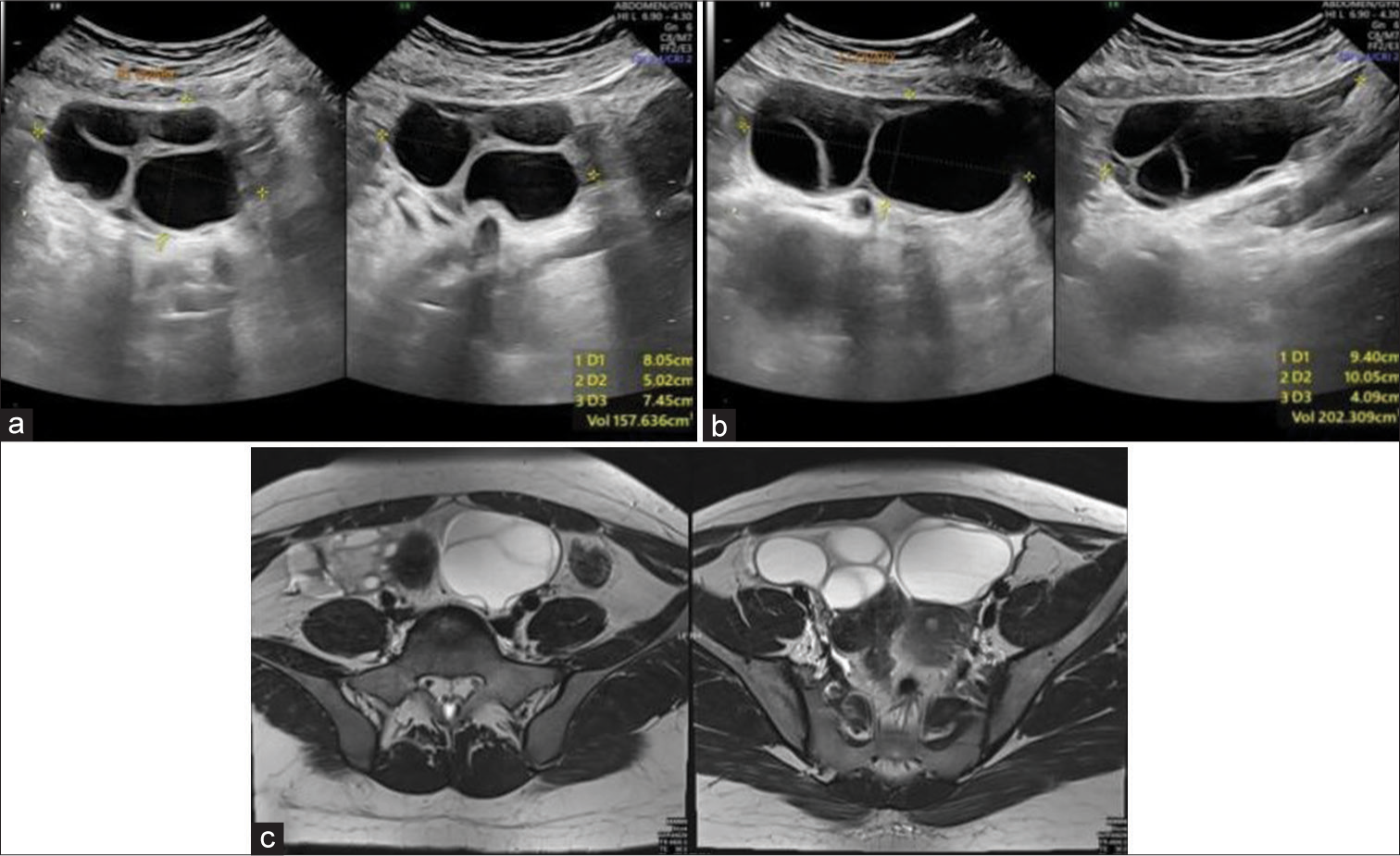 A 19-year-old female presented with ovarian hyperstimulation syndrome who presented with severe abdominal pain (a and b) ultrasound images showing bulky bilateral ovaries with multiple enlarged follicles and (c) axial T2-weighted magnetic resonance imaging section of the pelvis re-demonstrating the ultrasound findings of bulky ovaries with multiple follicles. No e/o torsion was noted.