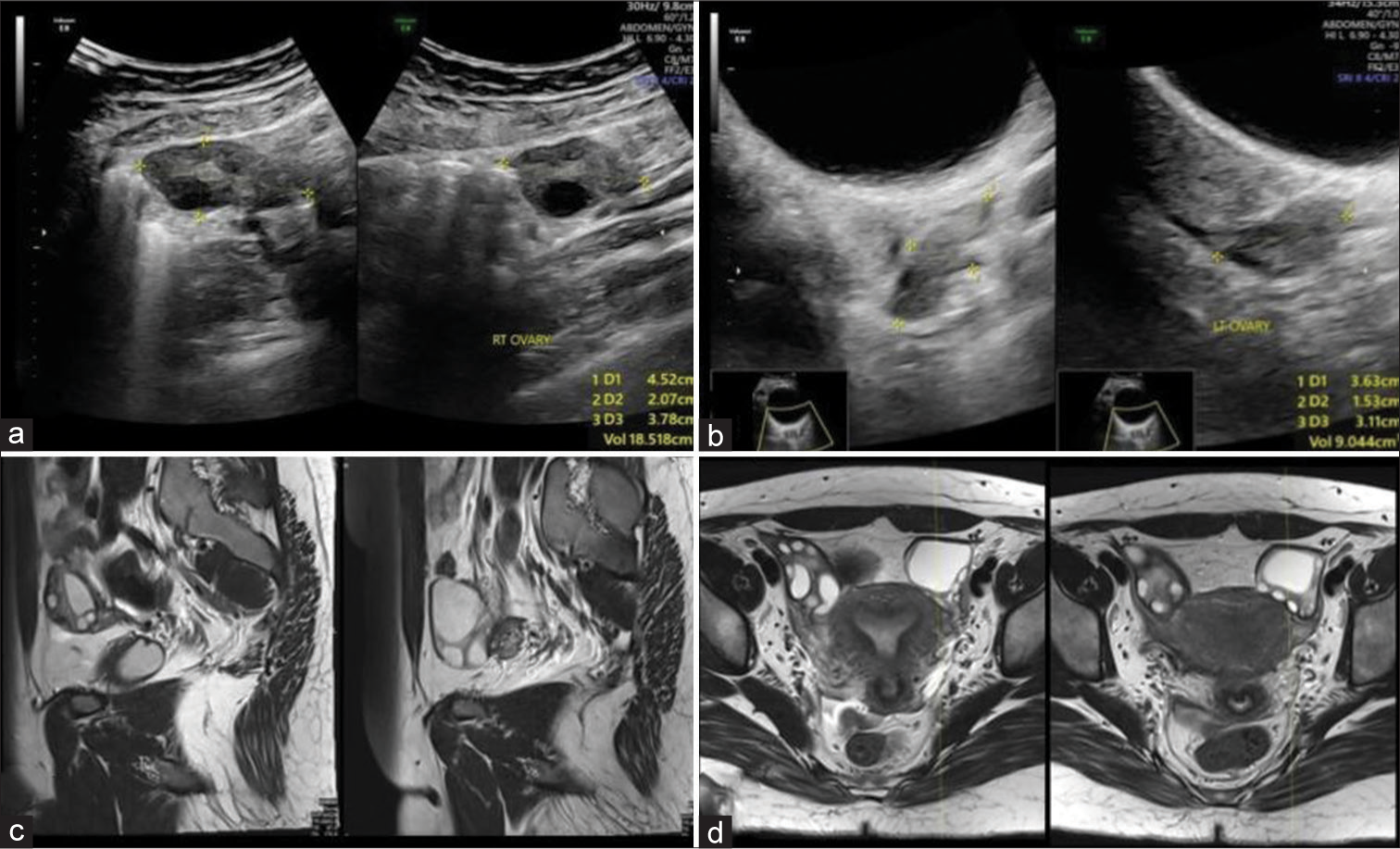 A 19-year-old female presented with ovarian hyperstimulation syndrome (OHSS) who had presented with severe abdominal pain, diagnosed as OHSS, on follow-up (a and b) Ultrasound images demonstrating the normal size and morphology of both ovaries at 5 month follow-up (c and d) sagittal and axial T2-weighted magnetic resonance imaging section of the pelvis re-demonstrating ultrasound findings suggesting complete resolution.