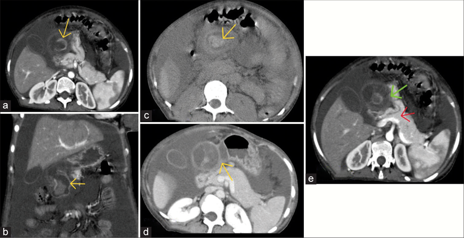 (a and b) Contrast-enhanced computed tomography scan of the abdomen reveals a well-defined cystic lesion with a multi-layered wall in the greater omentum. It has an intensely enhancing inner wall (yellow arrows) with the breech in its superolateral aspect. (c) On a plain scan, there is a hyperdense blood clot (yellow arrow) within the cystic lesion. (d) The cyst is sharing wall (yellow arrow) with the greater curvature of the stomach. (e) Accessory pancreatic lobe is seen communicating with the main pancreas. It contains an aberrant duct which communicates with the main pancreatic duct (red arrow) and cystic lesion (green arrow).