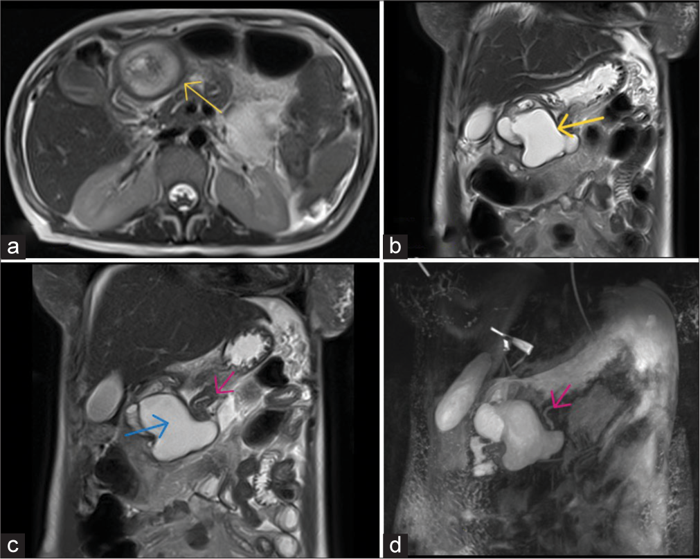 (a) Axial section of T2-weighted image of magnetic resonance imaging of the abdomen confirms the presence of T2 hyperintense cystic lesion with multilayered (T2 hyperintensehypointense-hyperintense) wall (yellow arrow). (b) Coronal T2-weighted section shows that the cyst is sharing wall with the greater curvature of stomach (yellow arrow). A breech is seen in its superolateral aspect. (c) Coronal T2-weighted section shows the accessory pancreatic lobe with the aberrant duct (pink arrow). There is T2 hypointense content within the cyst suggestive of blood clot (blue arrow). (d) Coronal 3D image shows the aberrant duct (pink arrow).