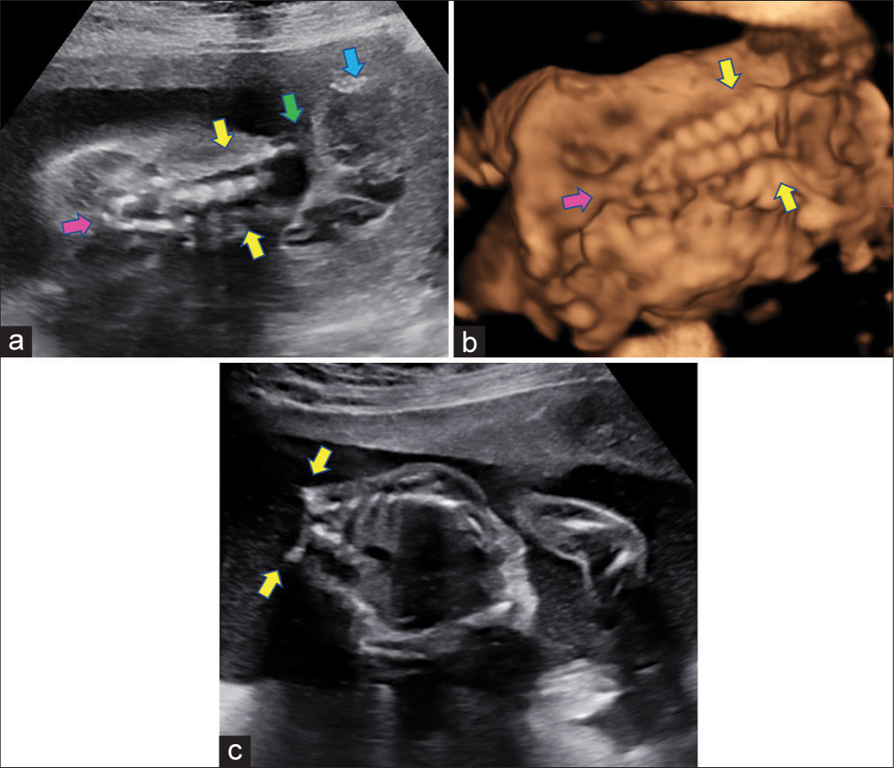 (a) Antenatal sonographic images of the fetus in the coronal plane of the fetus showing the fetal spine with widely splayed lamina at all levels (yellow arrows) with progressive narrowing and fusion at the caudal aspect (pink arrow). Also depicted is the absence of calvarium and exencephaly of the cerebral tissue (blue arrow) and the contiguity between the cranial and spinal defect (green arrow). (b) Antenatal 3 dimensional surface rendered images of the fetus in coronal plane reaffirming the findings and showing widely splayed lamina (yellow arrows), fusing inferiorly (pink arrow). (c) Antenatal sonographic images of the fetus in the axial/oblique plane showing absence of vertebral posterior elements with widely splayed laminae (yellow arrows), exposing the spinal cord to amniotic cavity suggesting rachischisis.