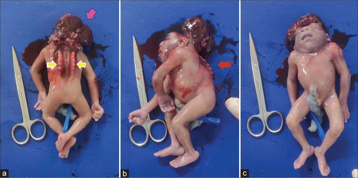 Postnatal images of the fetus (a) showing absent calvarium with exposed cerebral tissue (pink arrow) and contiguous rachischisis of the cervicothoracic spine (yellow arrows) confirming our antenatal diagnosis of craniospinal rachischisis. (b) Similar findings depicted in the sagittal plane. Note the abnormal spinal curvature (red arrow). Also, note the neutral position of fetal head in relation to the body and absence of thick skin covering the herniated structures which ruled out iniencephaly. (c) Note the prominent orbital structures, broad nose, absence of a distinguished neck structure, and low-set ears.