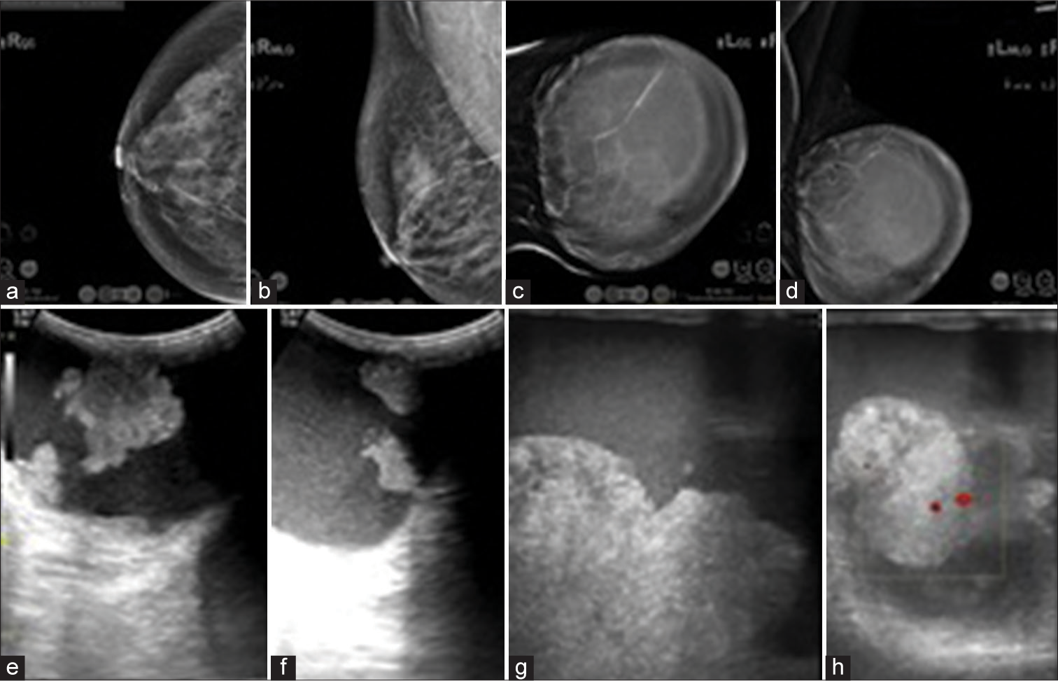 (a-d) Digital Breast Tomosynthesis images of both breasts; (e-f) US images of left breast. (a and b) CC and MLO views of right breast- BIRADS-1. (c and d) CC and MLO views of left breast show a large circumscribed mass lesion with variable density (central equal density and peripheral low density areas) causing stretching of overlying skin and deformity of left breast contour- BIRADS 4c. (e and f) low frequency US images and (g and h) high frequency US images of left breast show circumscribed complex cystic lesion with multiple irregular solid components and vascularity within the solid component. CC: Craniocaudal, MLO: Mediolateral oblique, BIRADS: Breast imaging reporting and data system, US: ultrasound.