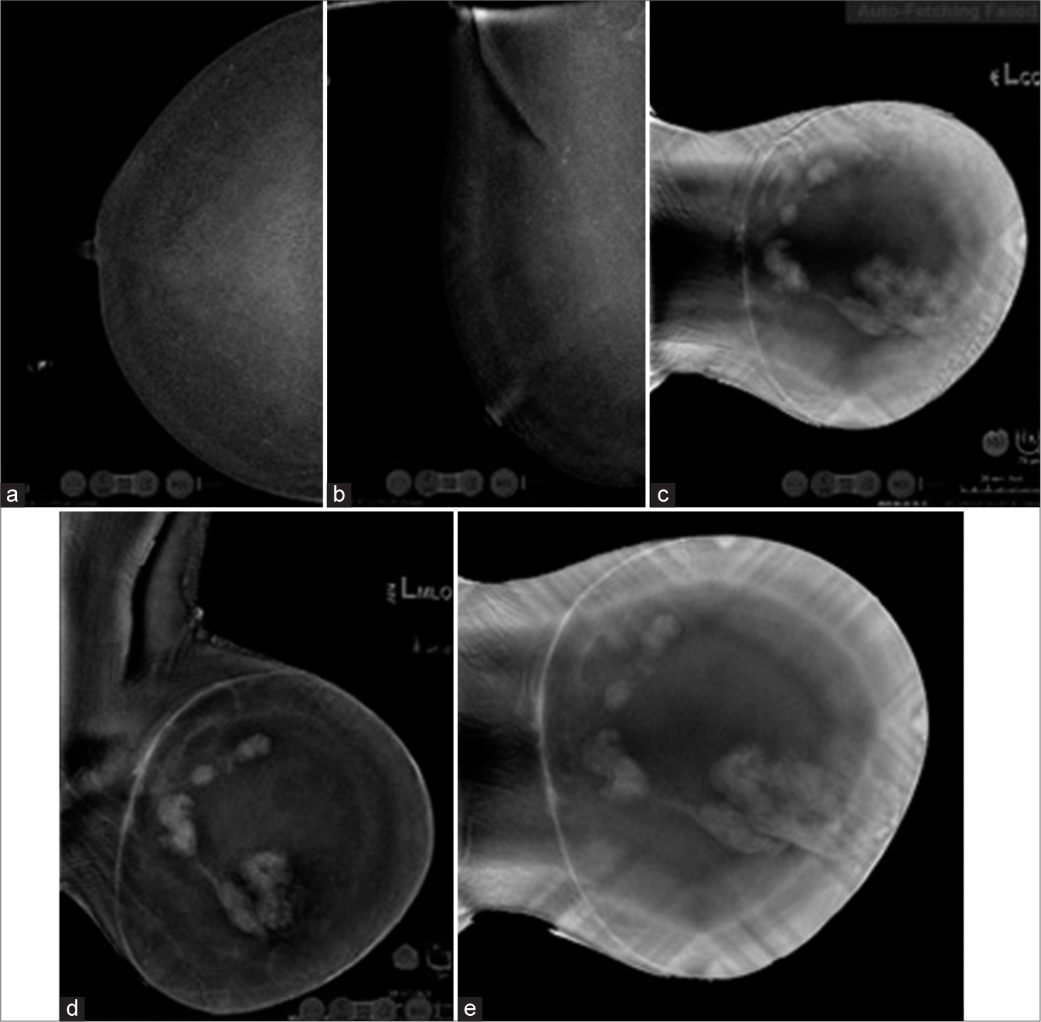 Contrast Enhanced Mammogram images. (a and b) Post contrast images of right breast show minimal background parenchymal enhancement with no abnormal enhancing lesion- BIRADS-1. (c) 2-min post CC view of left breast, (d) 4-min MLO view of left breast (e) 8-min (delayed) CC view of left breast show smooth thin rim enhancing mass with multiple enhancing mural nodules amidst adjacent negative internal enhancement with plateau kinetics in the delayed image as compared to the initial image- BIRADS 4c. CC: Craniocaudal, MLO: Mediolateral oblique, BIRADS: Breast imaging reporting and data system.