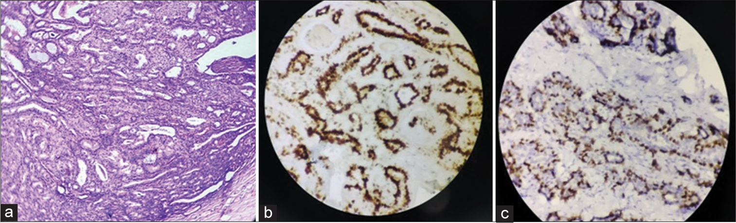 (a) Histopathological examination image- benign adenomyoepithelioma of breast, (b) immunohistochemistry (IHC) image-Estrogen receptor positive in myoepithelial cells, (c) IHC image-p63 positive in myoepithelial cells.