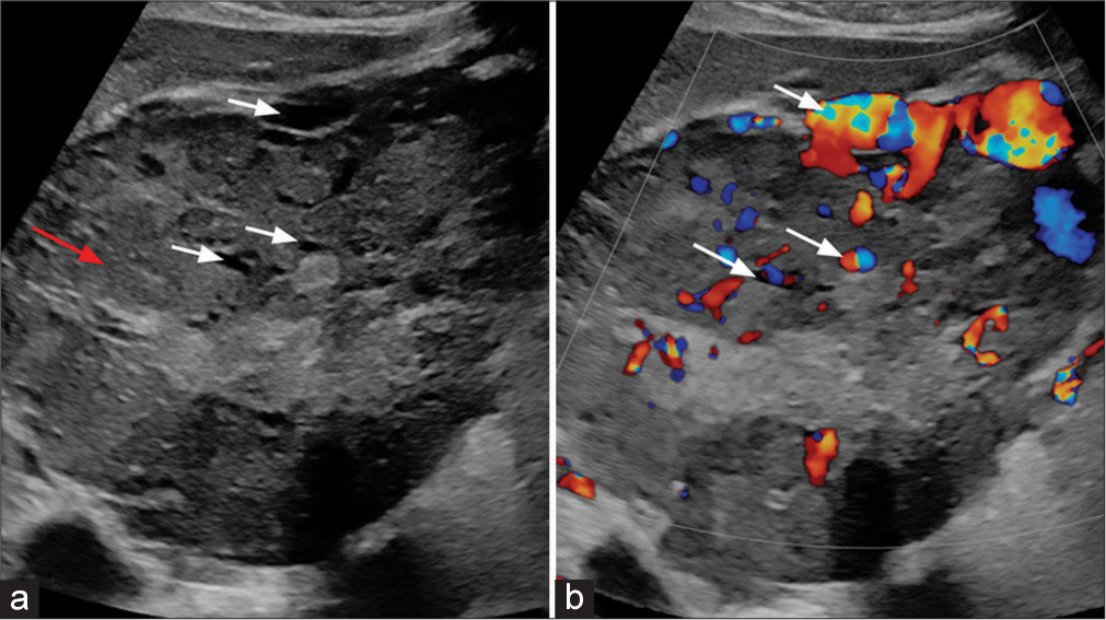 (a) B-Mode ultrasound image of liver shows a large heterogeneous lesion (red arrow) with multiple anechoic areas (white arrows). (b) Color Doppler image of liver shows a intralesional vascularity (white arrows).