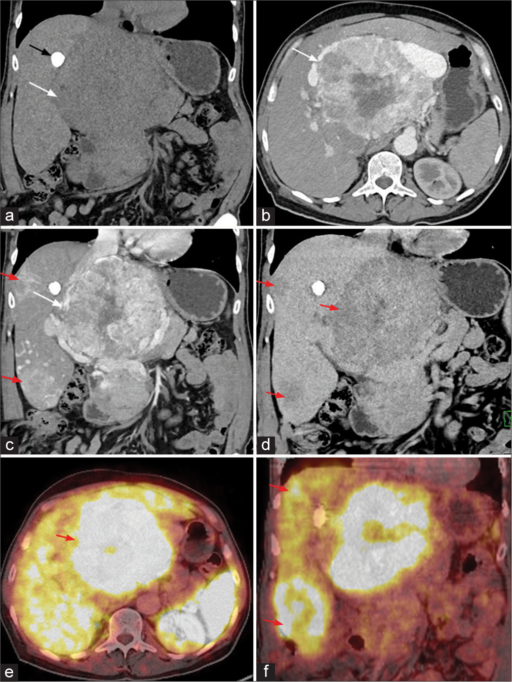 (a-d) Contrast-enhanced computed tomography (CT) image of the abdomen (a) coronal plain CT image shows a large heterogeneous lesion in the region of porta hepatis (white arrow) with focus of calcification (black arrow) along the margin of the lesion. (b) Arterial phase image shows a heterogeneous hyperenhancement of the lesion (white arrow). (c) Coronal image in the arterial phase shows a largest lesion in the porta hepatis region (white arrow). Similar lesions were also demonstrated in the subcapsular location in the right lobe of liver (red arrows). (d) All the lesions show washout on delayed phase (red arrows). (e) Axial and (f) coronal Ga-68 DOTONOC PET CT image shows intense tracer uptake in the lesion in region of porta hepatis (red arrow in e) and lesions in subcapsular region of the right lobe of liver (red arrows in f).